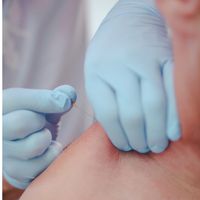 Nahaufnahme einer Dry-Needling-Behandlung mit behandschuhten Händen, die eine Nadel halten und in die Schulter eines Patienten einführen.